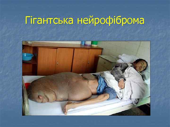 Гігантська нейрофіброма 