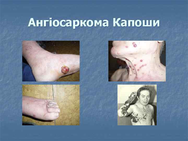 Ангіосаркома Капоши 