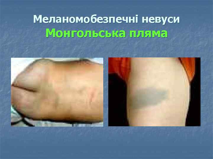 Меланомобезпечні невуси Монгольська пляма 