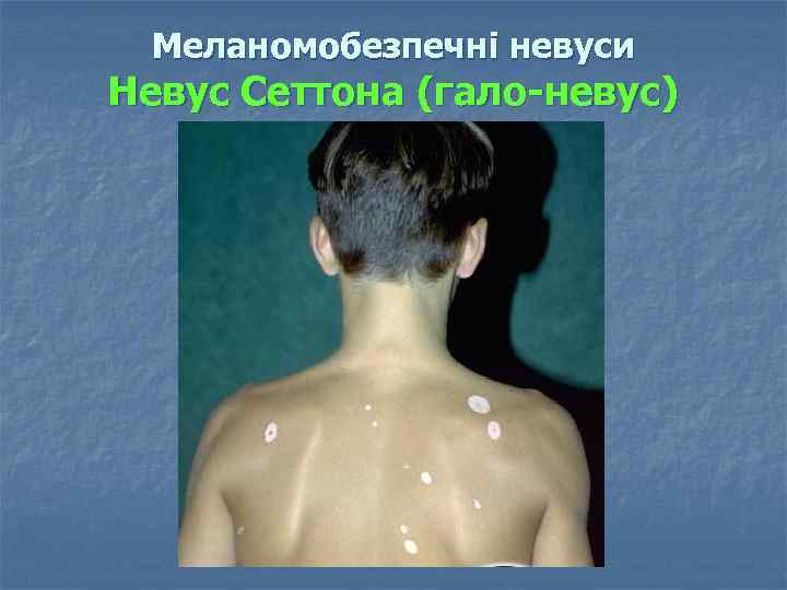 Меланомобезпечні невуси Невус Сеттона (гало-невус) 