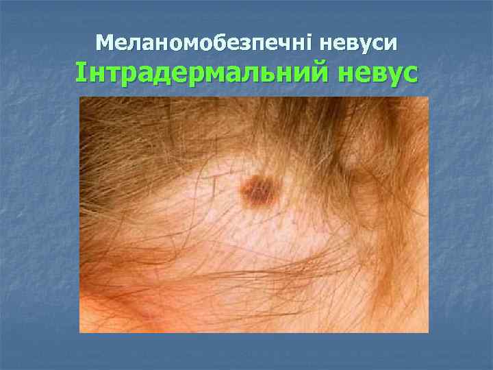 Меланомобезпечні невуси Інтрадермальний невус 