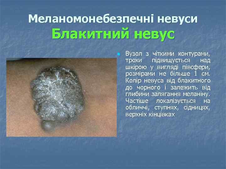 Меланомонебезпечні невуси Блакитний невус n Вузол з чіткими контурами, трохи підвищується над шкірою у
