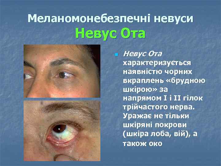 Меланомонебезпечні невуси Невус Ота n Невус Ота характеризується наявністю чорних вкраплень «брудною шкірою» за