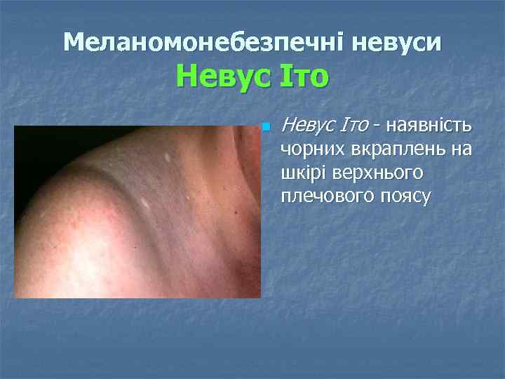 Меланомонебезпечні невуси Невус Іто n Невус Іто наявність чорних вкраплень на шкірі верхнього плечового