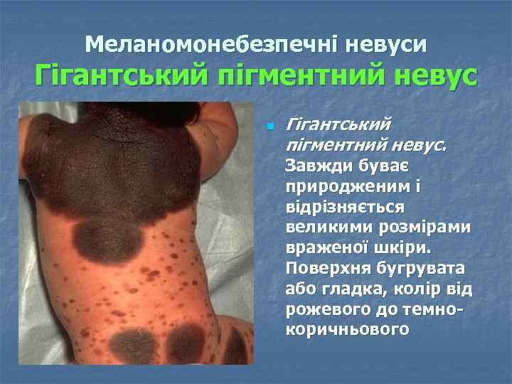 Меланомонебезпечні невуси Гігантський пігментний невус n Гігантський пігментний невус. Завжди буває природженим і відрізняється