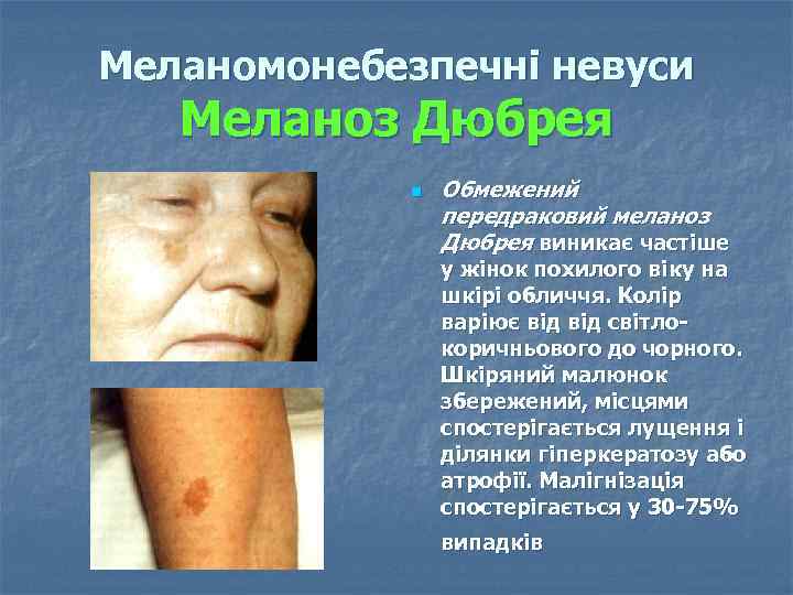 Меланомонебезпечні невуси Меланоз Дюбрея n Обмежений передраковий меланоз Дюбрея виникає частіше у жінок похилого