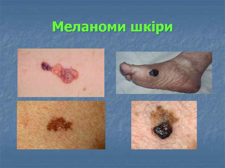Меланоми шкіри 