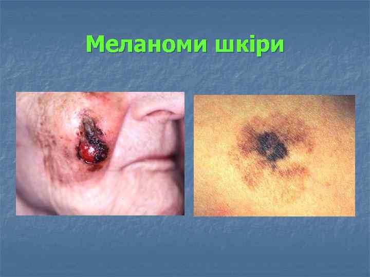 Меланоми шкіри 