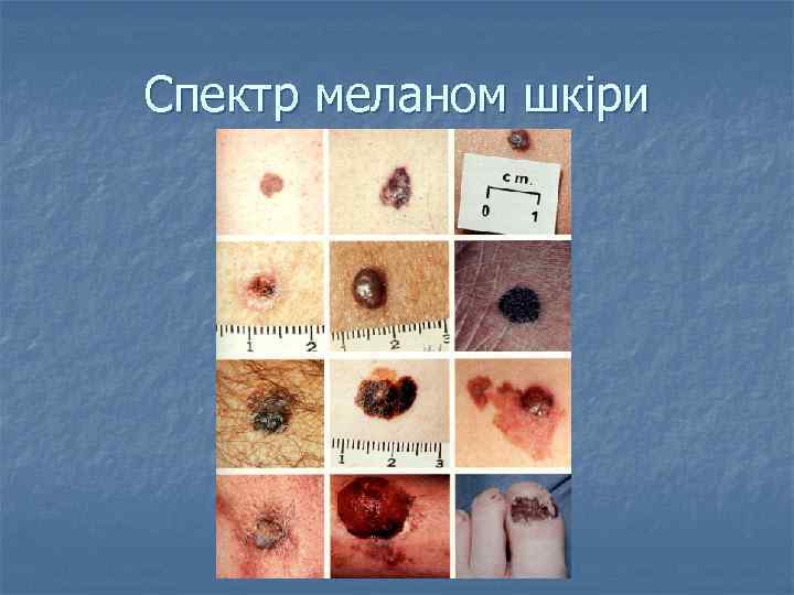 Спектр меланом шкіри 