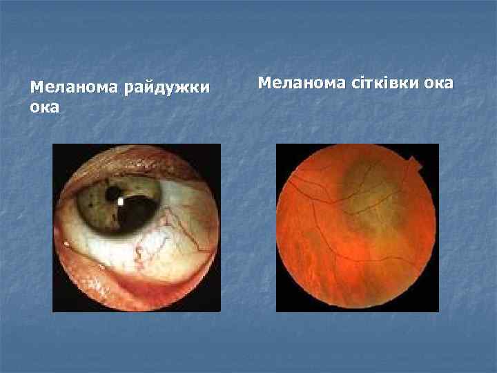 Меланома райдужки ока Меланома сітківки ока 