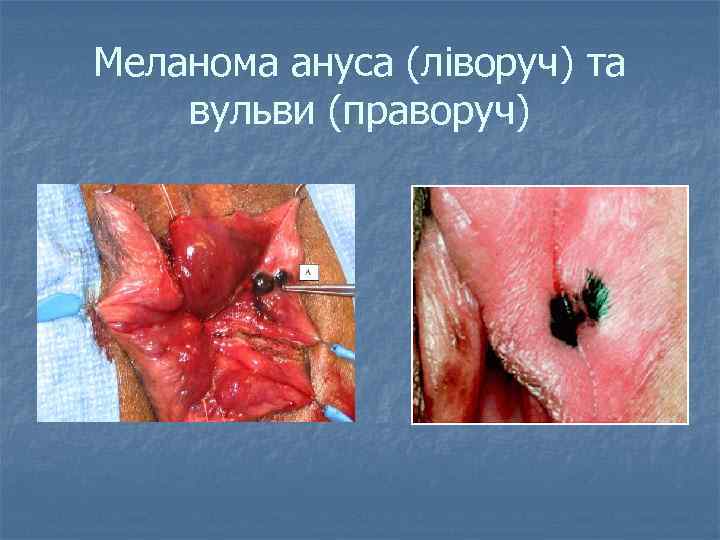 Меланома ануса (ліворуч) та вульви (праворуч) 