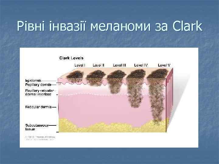 Рівні інвазії меланоми за Clark 