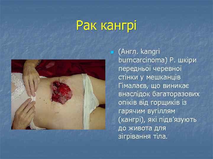 Рак кангрі n (Англ. kangri burncarcinoma) Р. шкіри передньої черевної стінки у мешканців Гімалаєв,