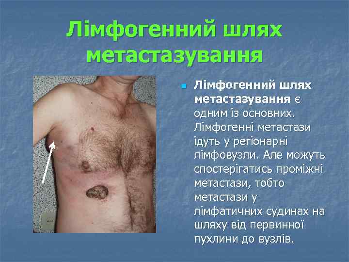Лімфогенний шлях метастазування n Лімфогенний шлях метастазування є одним із основних. Лімфогенні метастази ідуть