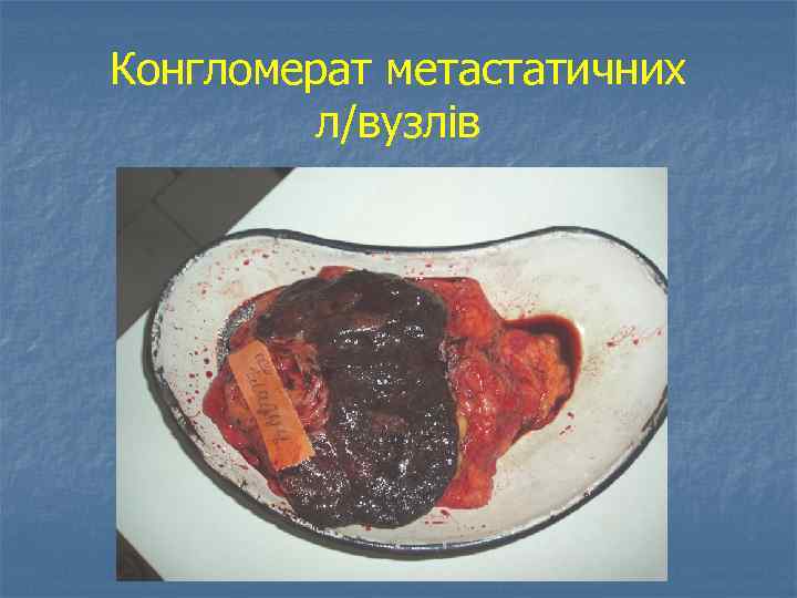 Конгломерат метастатичних л/вузлів 