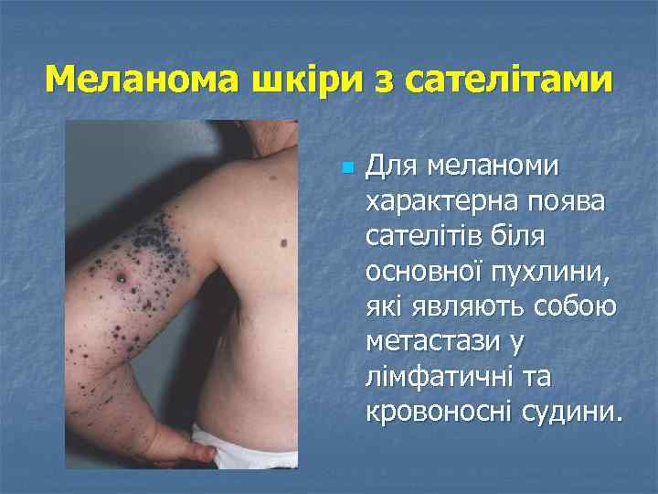 Меланома шкіри з сателітами n Для меланоми характерна поява сателітів біля основної пухлини, які