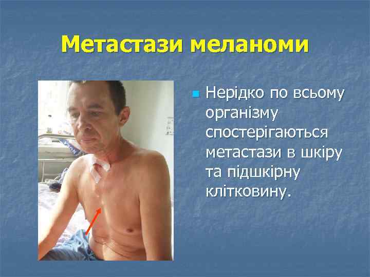 Метастази меланоми n Нерідко по всьому організму спостерігаються метастази в шкіру та підшкірну клітковину.