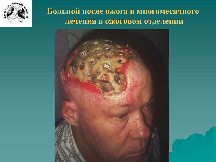 Больной после ожога и многомесячного лечения в ожоговом отделении 