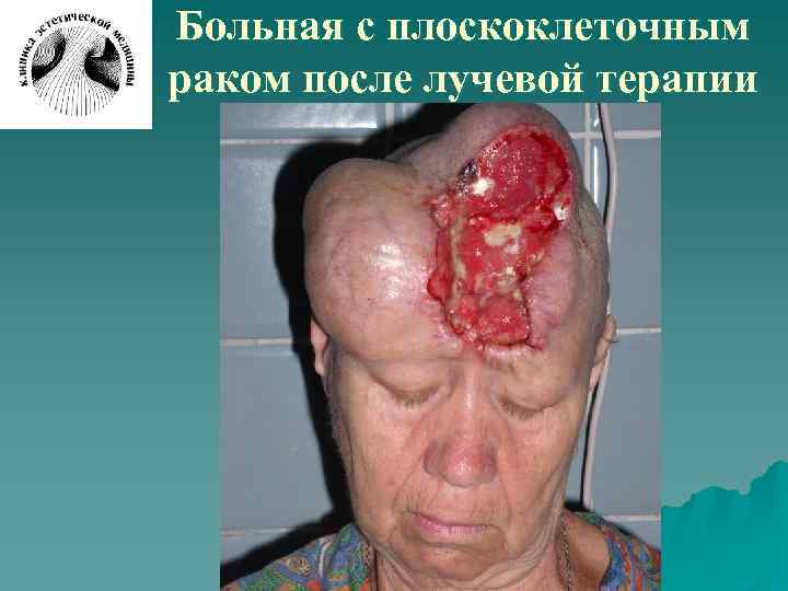 Больная с плоскоклеточным раком после лучевой терапии 
