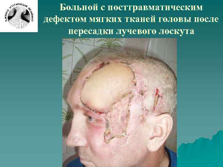Больной с посттравматическим дефектом мягких тканей головы после пересадки лучевого лоскута 