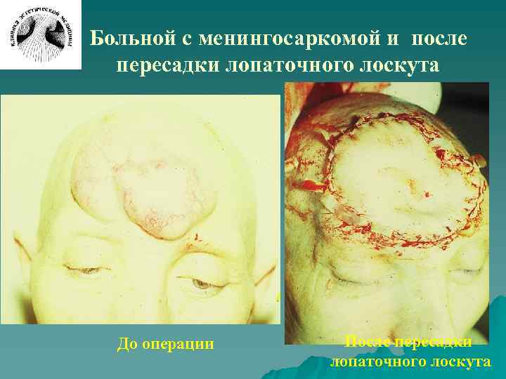 Больной с менингосаркомой и после пересадки лопаточного лоскута До операции После пересадки лопаточного лоскута