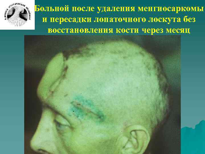 Больной после удаления менгиосаркомы и пересадки лопаточного лоскута без восстановления кости через месяц 