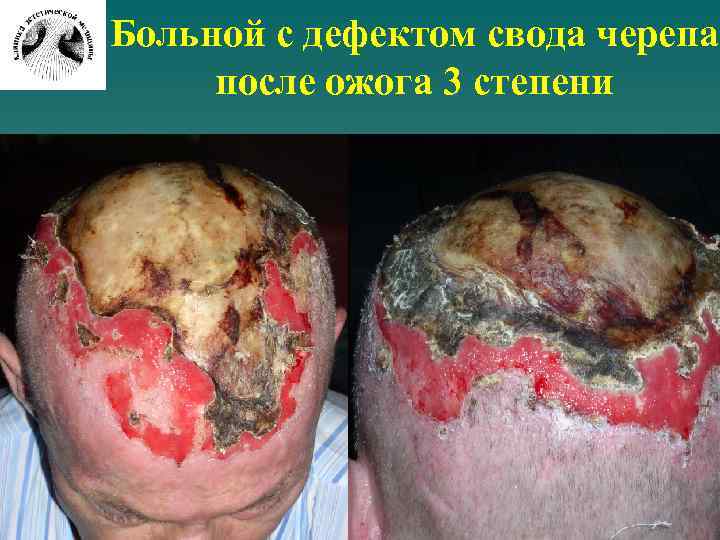 Больной с дефектом свода черепа после ожога 3 степени 