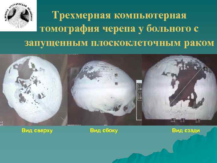 Трехмерная компьютерная томография черепа у больного с запущенным плоскоклеточным раком Вид сверху Вид сбоку