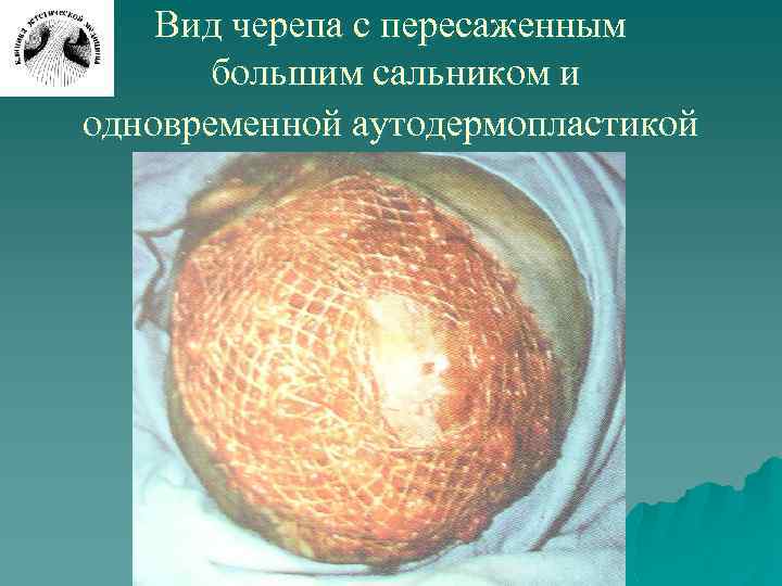 Вид черепа с пересаженным большим сальником и одновременной аутодермопластикой 