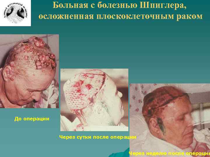 Больная с болезнью Шпиглера, осложненная плоскоклеточным раком До операции Через сутки после операции Через