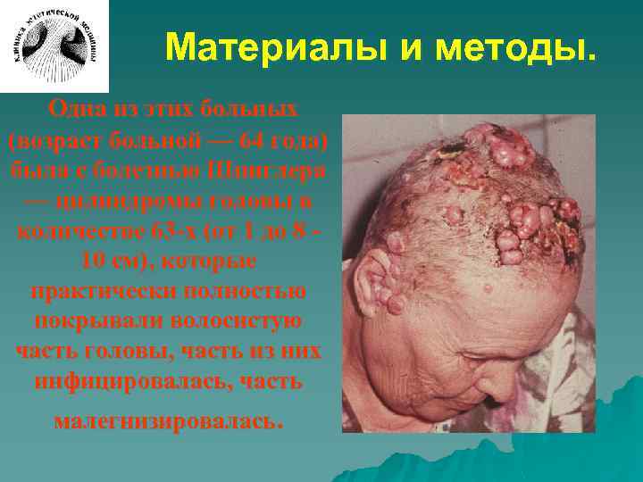 Материалы и методы. Одна из этих больных (возраст больной — 64 года) была с