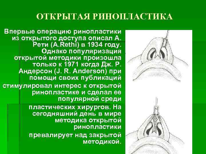 ОТКРЫТАЯ РИНОПЛАСТИКА Впервые операцию ринопластики из открытого доступа описал А. Рети (А. Rethi) в