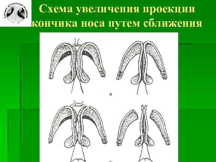 Схема увеличения проекции кончика носа путем сближения куполов 