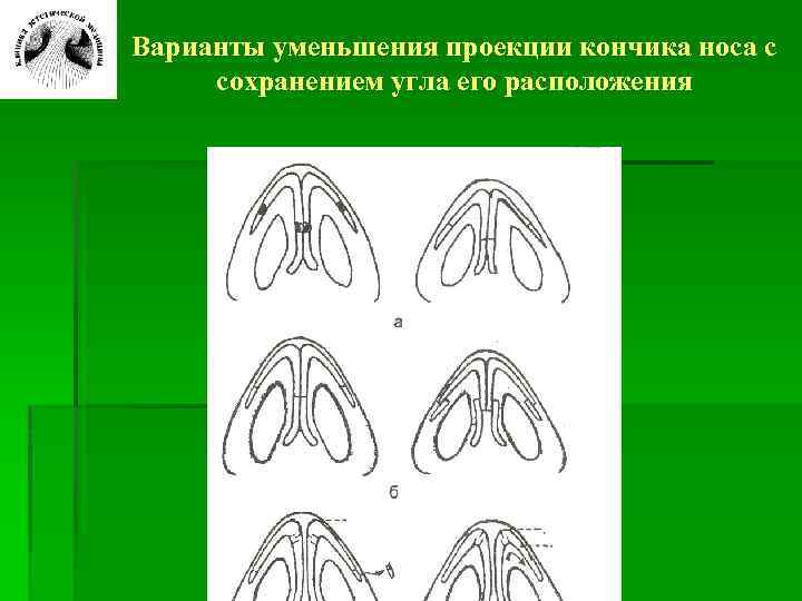 Проекция носа. Депроекция кончика носа. Высокая проекция кончика носа. Понижать проекцию носа.