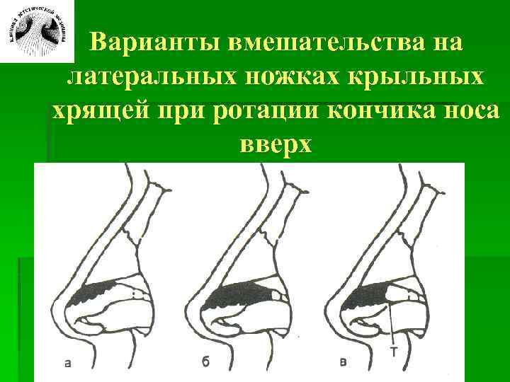 Варианты вмешательства на латеральных ножках крыльных хрящей при ротации кончика носа вверх 