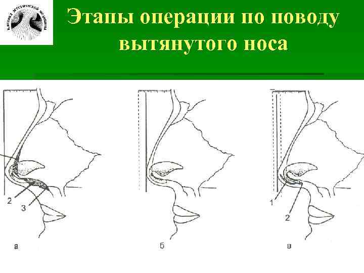 Этапы операции по поводу вытянутого носа 