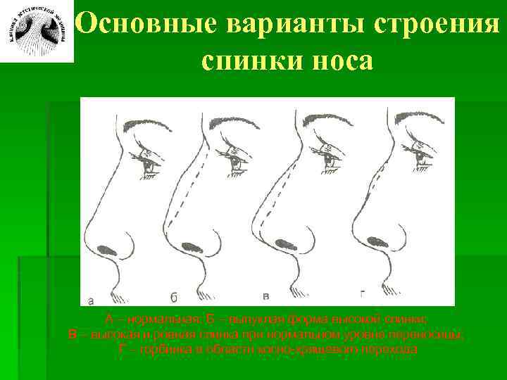 Основные варианты строения спинки носа А – нормальная; Б – выпуклая форма высокой спинки;