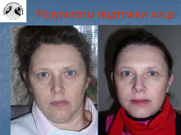 Результаты подтяжки лица 