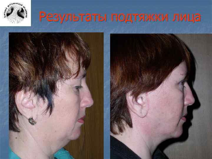 Результаты подтяжки лица 