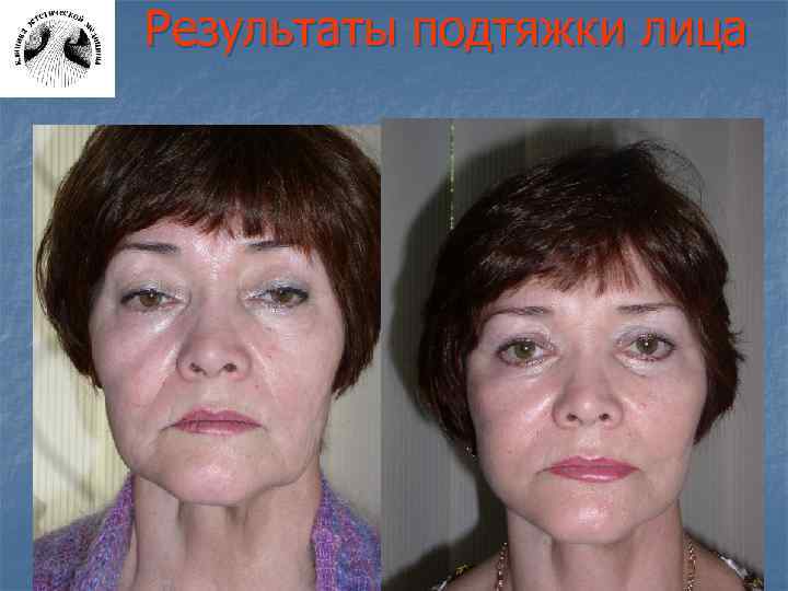 Результаты подтяжки лица 