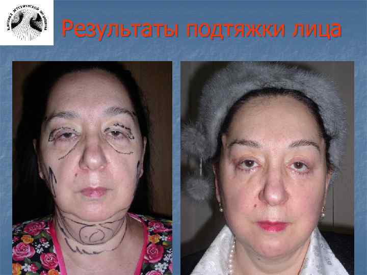 Результаты подтяжки лица 