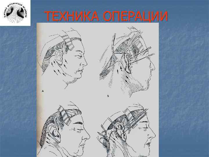 ТЕХНИКА ОПЕРАЦИИ 