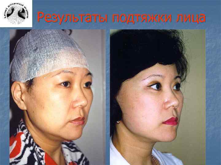 Результаты подтяжки лица 