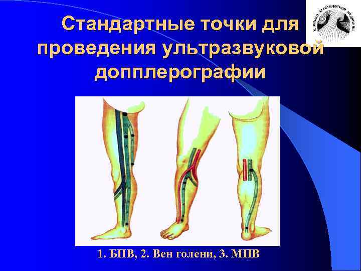 Стандартные точки для проведения ультразвуковой допплерографии 1. БПВ, 2. Вен голени, 3. МПВ 