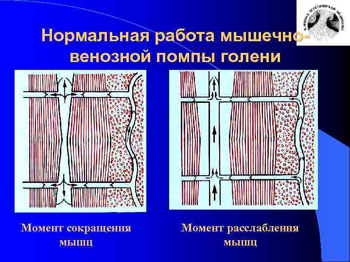 Нормальная работа мышечновенозной помпы голени Момент сокращения мышц Момент расслабления мышц 