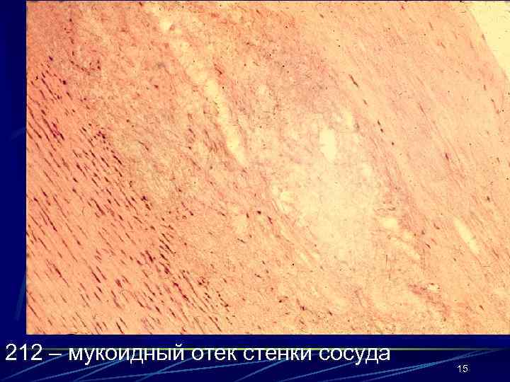 212 – мукоидный отек стенки сосуда 15 