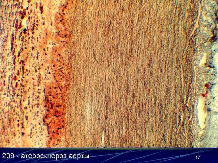 209 - атеросклероз аорты 17 