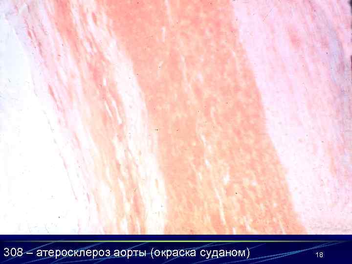 308 – атеросклероз аорты (окраска суданом) 18 