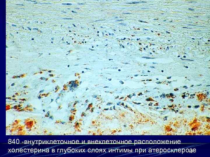 840 -внутриклеточное и внеклеточное расположение холестерина в глубоких слоях интимы при атеросклерозе 19 