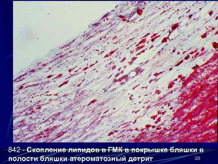 842 - Скопление липидов в ГМК в покрышке бляшки в 22 полости бляшки атероматозный